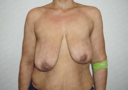 Breast Lift Before & After Patient #1989