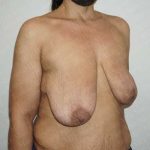 Breast Lift Before & After Patient #1989