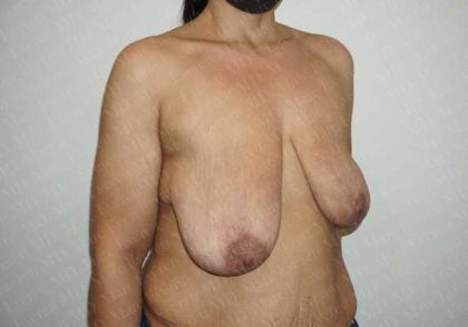 Breast Lift Before & After Patient #1989