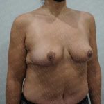 Breast Lift Before & After Patient #1989