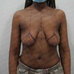 Breast Lift Before & After Patient #1988