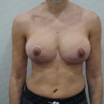 Breast Lift Before & After Patient #1986