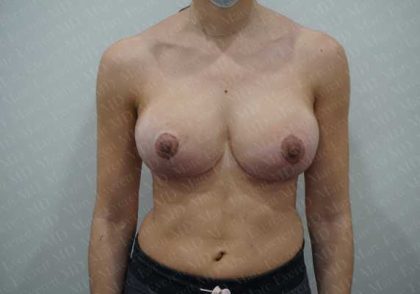 Breast Lift Before & After Patient #1986