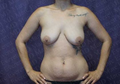 Breast Lift Before & After Patient #1981