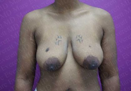 Breast Lift With Implant Before & After Patient #2027