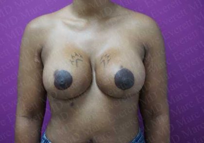 Breast Lift With Implant Before & After Patient #2027