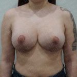 Breast Lift With Implant Before & After Patient #2026