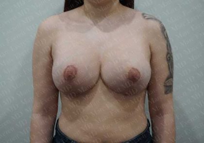 Breast Lift With Implant Before & After Patient #2026