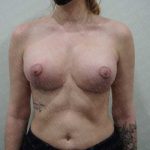 Breast Lift With Implant Before & After Patient #2025