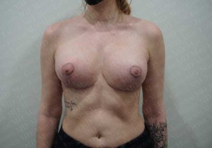 Breast Lift With Implant Before & After Patient #2025