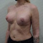 Breast Lift With Implant Before & After Patient #2025