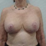 Breast Lift With Implant Before & After Patient #2001