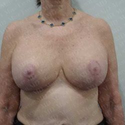 Breast Lift With Implant Before & After Patient #2001