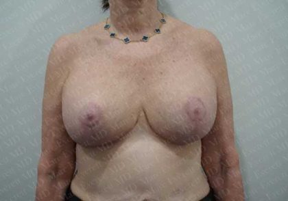 Breast Lift With Implant Before & After Patient #2001
