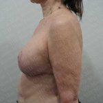 Breast Lift With Implant Before & After Patient #2001