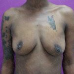 Breast Lift With Implant Before & After Patient #2000