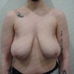 Breast Reduction Before & After Patient #1480
