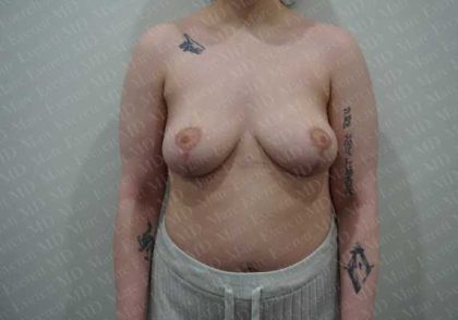Breast Reduction Before & After Patient #1480