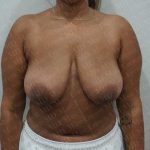 Breast Reduction Before & After Patient #1464