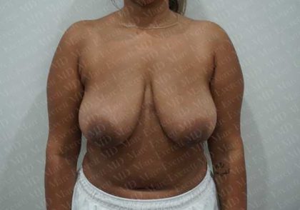 Breast Reduction Before & After Patient #1464