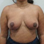 Breast Reduction Before & After Patient #1464