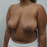 Breast Reduction Before & After Patient #1464
