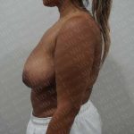 Breast Reduction Before & After Patient #1464