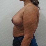 Breast Reduction Before & After Patient #1464