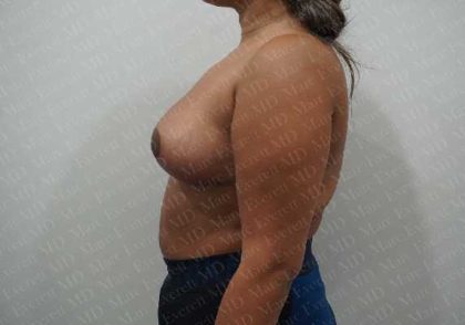 Breast Reduction Before & After Patient #1464