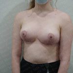 Breast Reduction Before & After Patient #1463