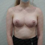 Breast Reduction Before & After Patient #1463