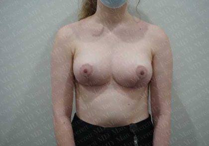 Breast Reduction Before & After Patient #1463