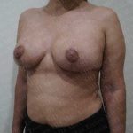 Breast Reduction Before & After Patient #1461