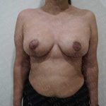 Breast Reduction Before & After Patient #1461