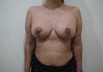 Breast Reduction Before & After Patient #1461