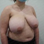 Breast Reduction Before & After Patient #1460