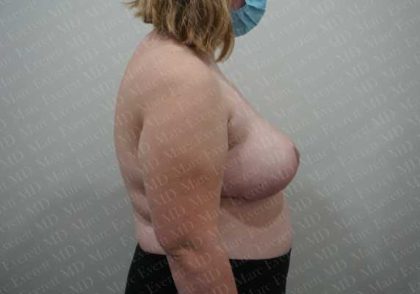 Breast Reduction Before & After Patient #1435