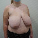 Breast Reduction Before & After Patient #1435