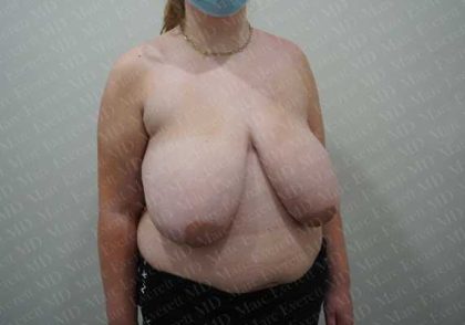 Breast Reduction Before & After Patient #1435