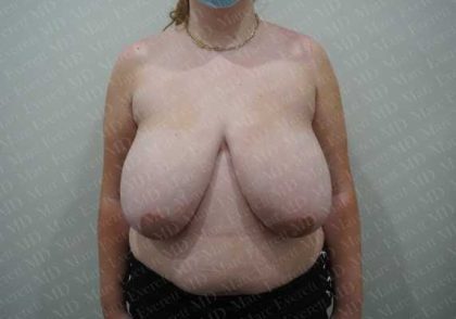 Breast Reduction Before & After Patient #1435