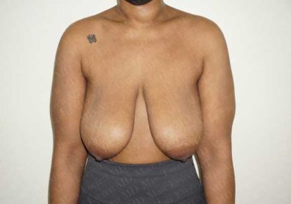 Breast Reduction Before & After Patient #1403
