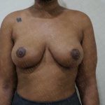 Breast Reduction Before & After Patient #1403