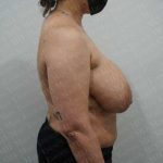 Breast Reduction Before & After Patient #1402