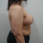 Breast Reduction Before & After Patient #1402