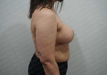 Breast Reduction Before & After Patient #1402