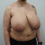 Breast Reduction Before & After Patient #1402