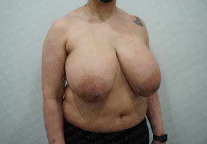 Breast Reduction Before & After Patient #1402