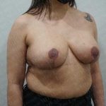 Breast Reduction Before & After Patient #1402