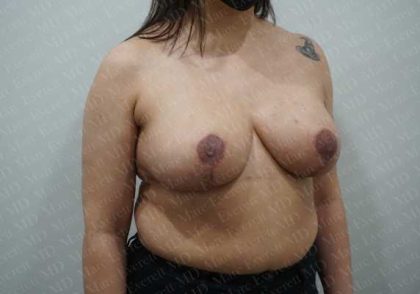 Breast Reduction Before & After Patient #1402