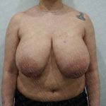 Breast Reduction Before & After Patient #1402
